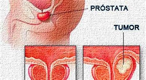 Cáncer De Próstata En Varones Se Incrementa Con La Edad   La Jiribilla