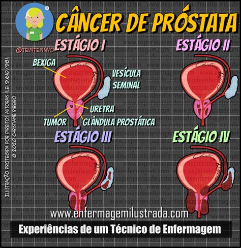 Câncer de Próstata   Enfermagem Ilustrada