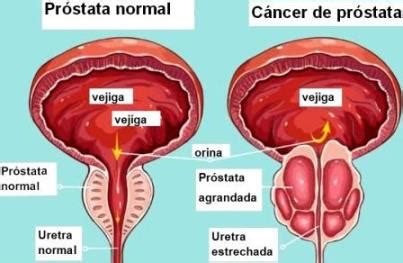 Cáncer de próstata es el cáncer más frecuente en los varones peruanos