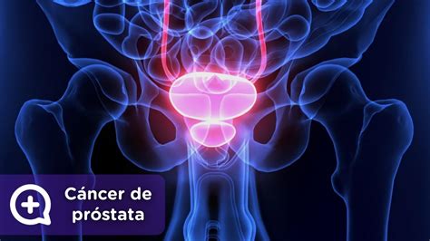 Cáncer de próstata: información y síntomas   mediQuo
