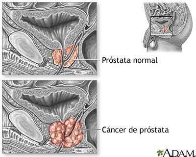 Cáncer de próstata: MedlinePlus enciclopedia médica