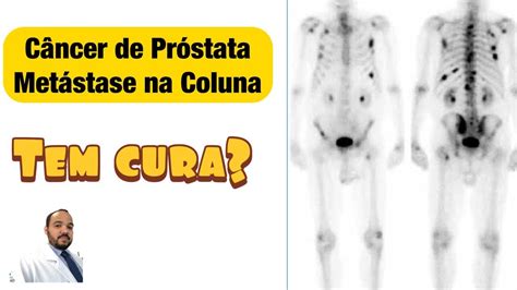 Câncer de Próstata Metástase tem cura? YouTube