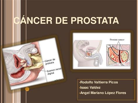 Cáncer de prostata