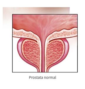 Cáncer de Próstata ¿Qué es?   Tratamiento y síntomas