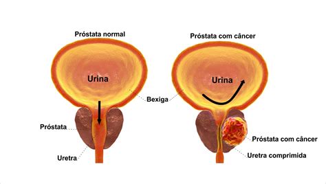Câncer de Próstata – Definições e Sintomas   Clínica Afetus