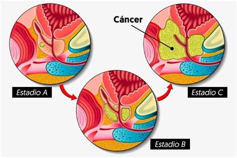 Cáncer de próstata: síntomas, causas y tratamiento   Tua Saúde