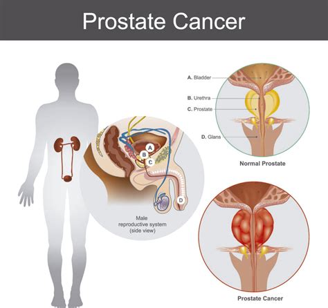Cáncer de Próstata: Síntomas, factores de riesgo y tratamiento