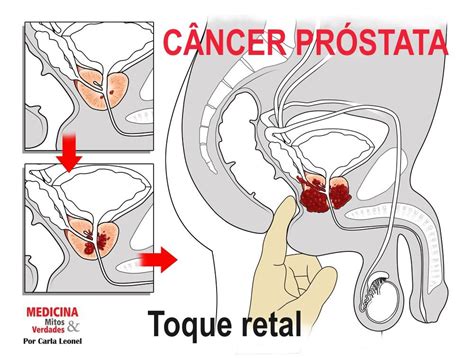 Cancer de prostata sintomas iniciais   Cancer de prostata ...