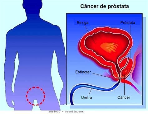 Câncer de próstata, sintomas, tratamento, mortalidade e ...