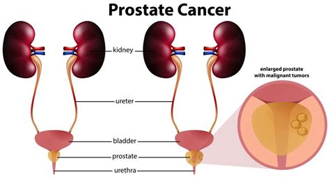 Cáncer de próstata sobre fondo blanco 302739 Vector en ...