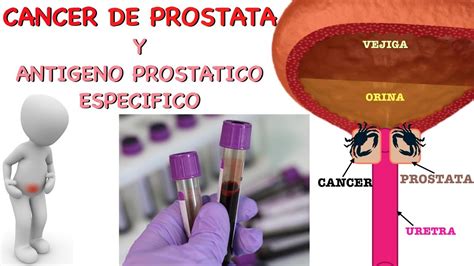 Cancer de Prostata y Antigeno Prostatico Especifico   YouTube