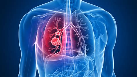 Cáncer de pulmón: causas, síntomas y tratamiento