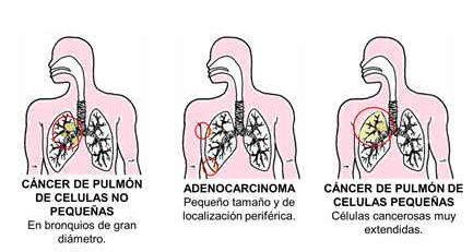 Cancer De Pulmon De Celulas No Pequeñas   Compartir Celular
