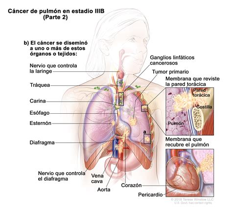 Cáncer de pulmón de células no pequeñas  PDQ —Versión ...