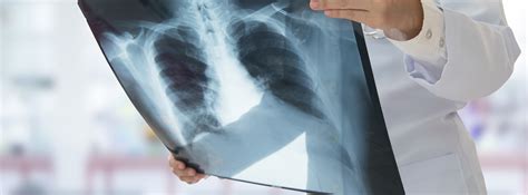 Cáncer de pulmón: diagnóstico y tratamiento  canalSALUD