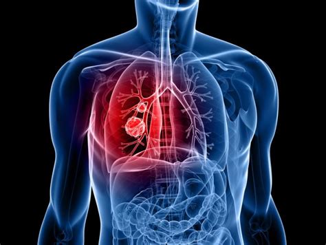 Cáncer de pulmón en estadio 4: Signos, Tratamiento y Más ...