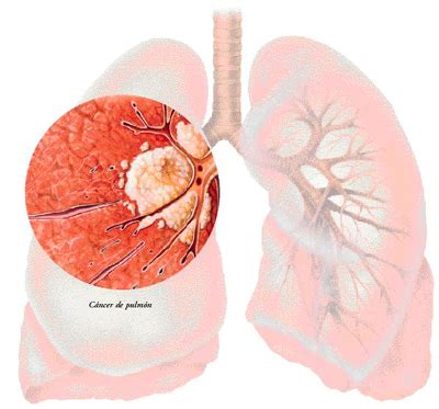 Cáncer de pulmón   Escuelapedia   Recursos Educativos