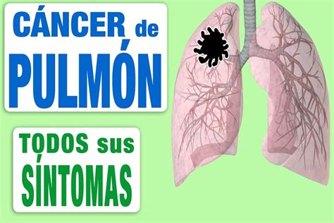 Cáncer de pulmón: estudian cómo mejorar el diagnóstico ...