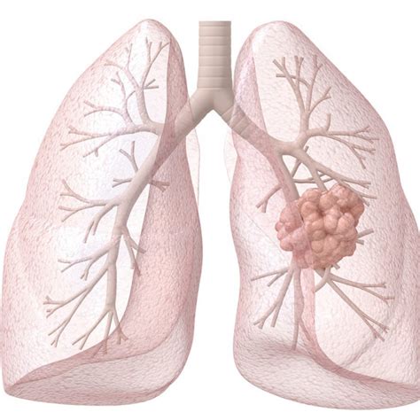 Cáncer de pulmón   Grupo Recoletas