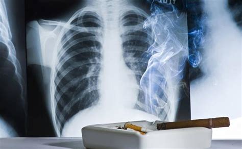 Cáncer de pulmón: los síntomas para detectar el cáncer más ...