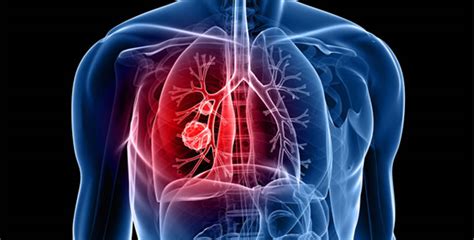 Cancer de pulmon sintomas iniciales que no debe ignorar ¡Atención!