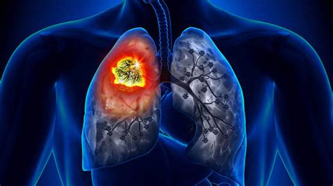 Cancer de pulmon sintomas iniciales que no debe ignorar ...