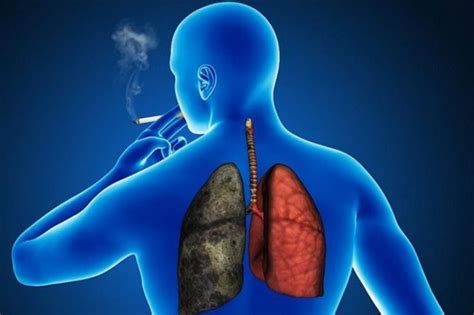 Cáncer de pulmón   Síntomas, tipos, tratamiento y ...