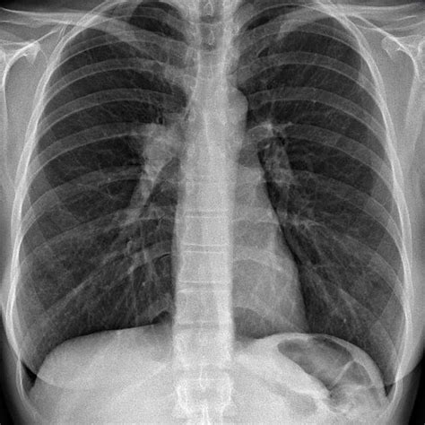 Cáncer de pulmón: una carrera humanitaria contra la muerte