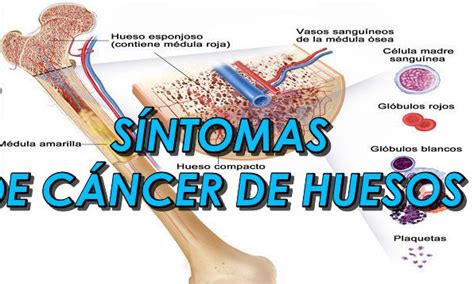 Cancer De Rodilla En Adultos Sintomas   CancerWalls