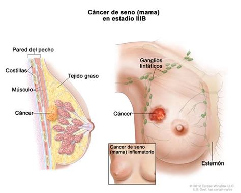 Cáncer de seno  mama    National Cancer Institute