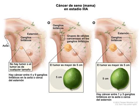 Cáncer de seno  mama   PDQ —Versión para pacientes ...