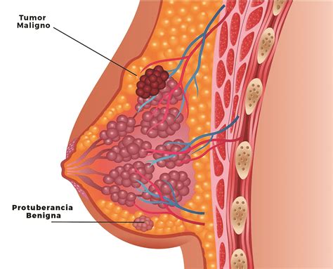 Cáncer de seno | Medimagen