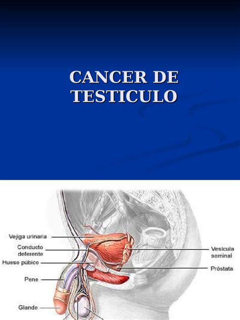 Cancer de Testiculo | Metástasis | Testículo