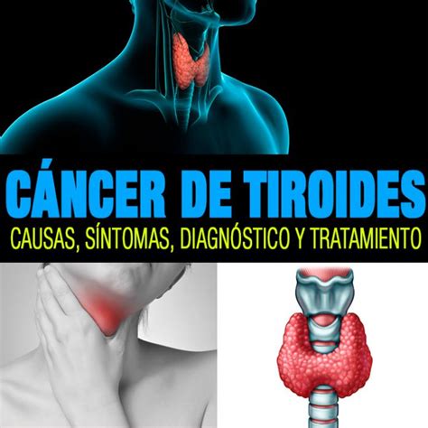 Cáncer de tiroides causas síntomas diagnóstico y ...