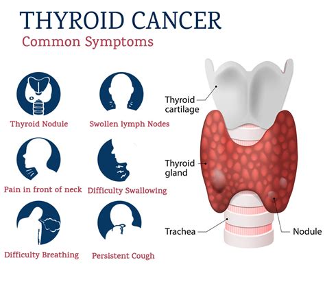Cáncer de tiroides: causas, síntomas y tratamiento