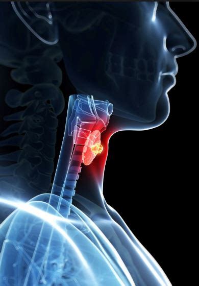 Cáncer de tiroides   Causas, síntomas y tratamiento
