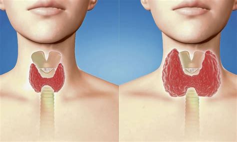 Cáncer de tiroides, un mal que afecta más a las mujeres ...