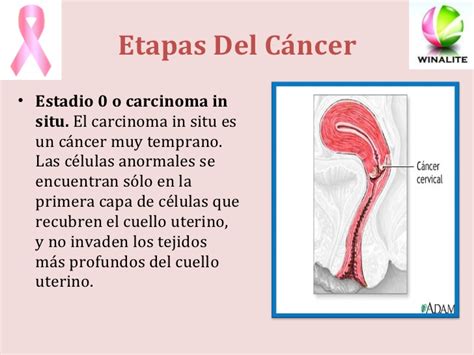 Cancer de utero  eli