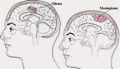 Cancer del Cerebro: Diferentes tipos de tumores cerebrales