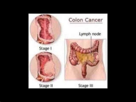 cancer del colon Causas sintomas y tratamientos para este ...