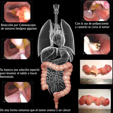 Cáncer del Colon  Gastroenterologia El Salvador   murrasaca.com