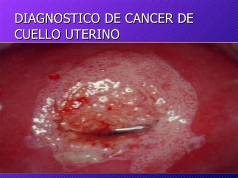 Cancer Del Cuello Uterino