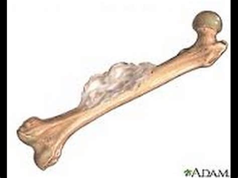 cancer en los huesos como prevenirlo bone cancer and ...