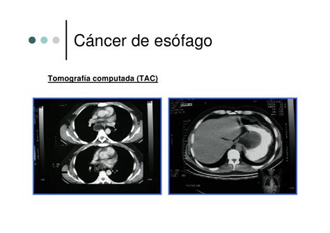 Cancer Estomago Con Metastasis   SEONegativo.com