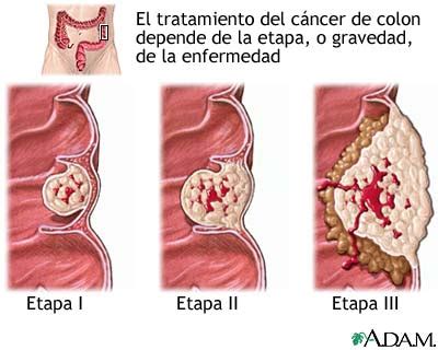 Cancer: FASES DEL CANCER
