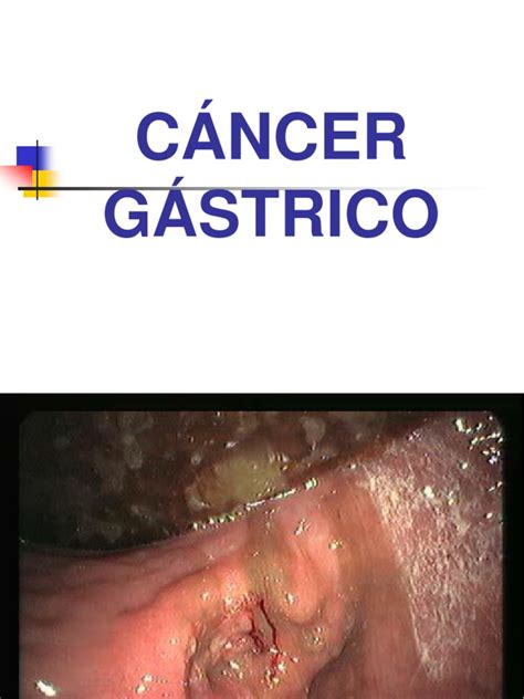 Cancer Gastrico | Cáncer | Metástasis
