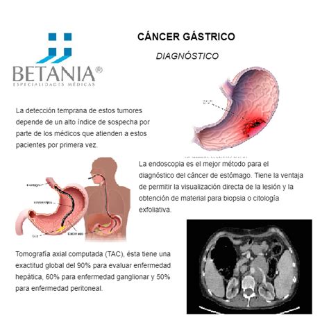 CÁNCER GÁSTRICO   DIAGNÓSTICO | Cancer gastrico, Cancer de estomago ...