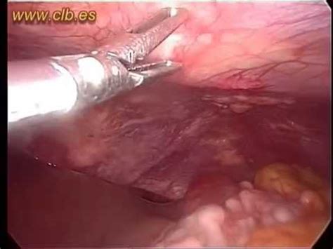 Cáncer Gástrico: Implantes  Centro Laparoscópico Dr ...