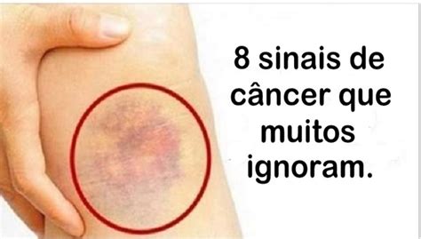 Cancer Huesos Sintomas Iniciales   SEONegativo.com