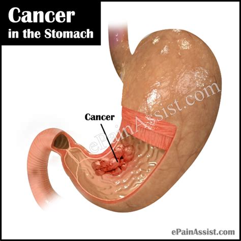 Cancer in the Stomach|Causes|Symptoms|Stages|Treatment ...